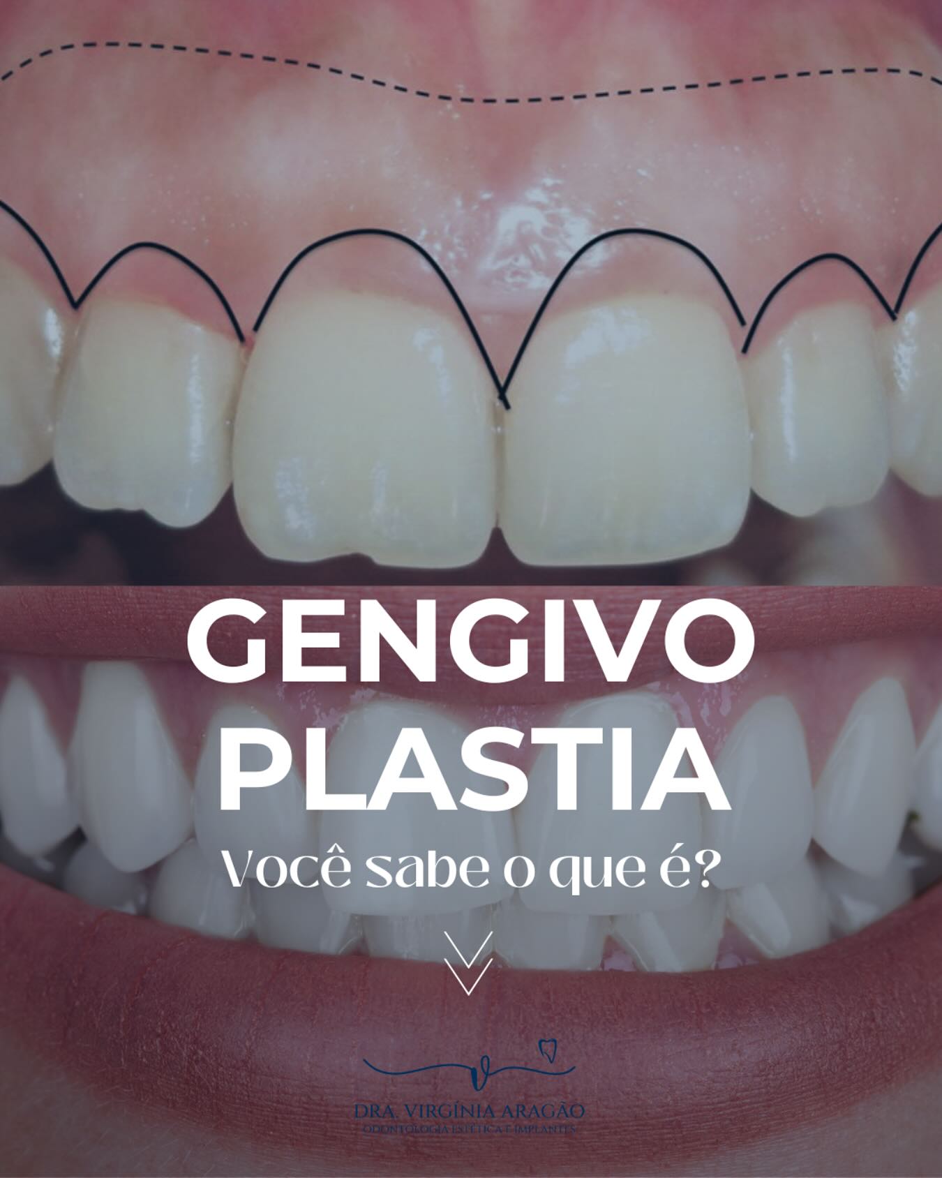 Antes e depois de gengivoplastia