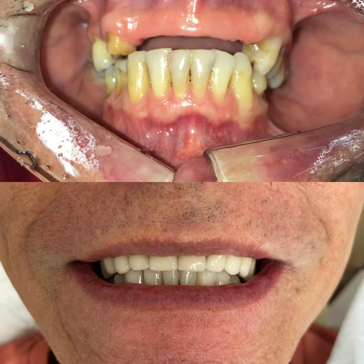 Sorriso reabilitado com implantes dentários